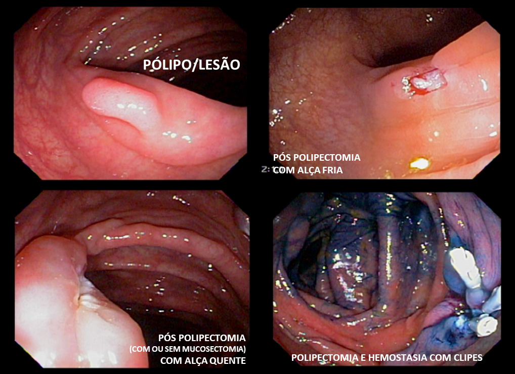 Plasma Argonio